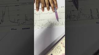 กราฟ Fhs Uterine Contraction