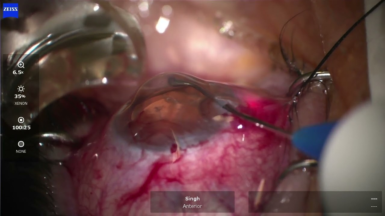 Interventional Glaucoma - iTrack Canaloplasty post Durysta - I Paul Singh, MD