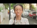 The Girl Whose Skin Peels Off | BORN DIFFERENT