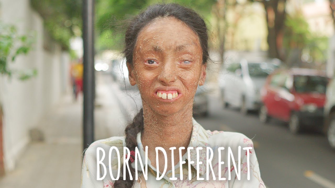 The Girl Whose Skin Peels Off | BORN DIFFERENT