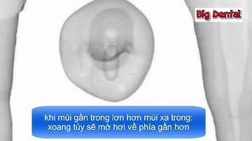 6 Giải phẫu ống tủy răng cối nhỏ thứ hai hàm dưới