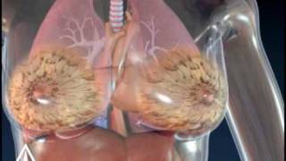 Breast Cancer Biopsy - 3D Medical Animation