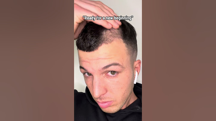 PRIMA E DOPO TRAPIANTO DI CAPELLI