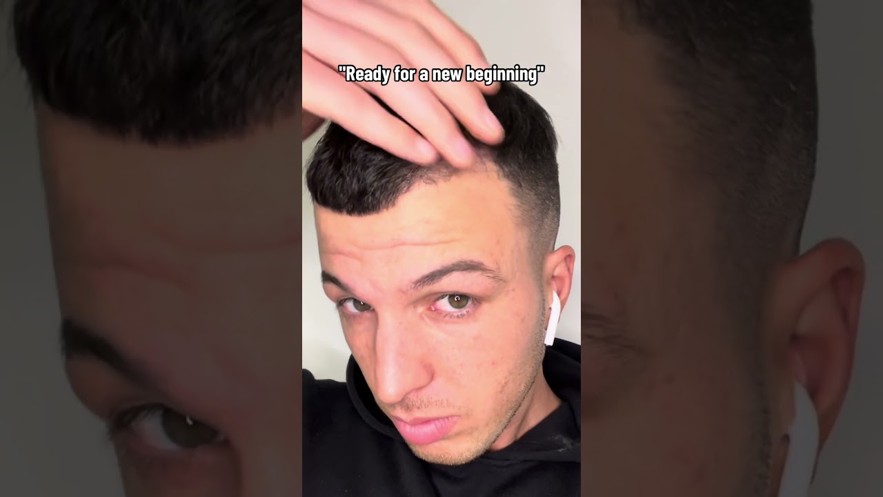 PRIMA E DOPO TRAPIANTO DI CAPELLI