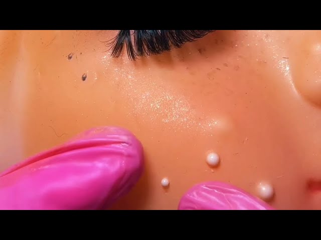 Extracción de granitos - ASMR