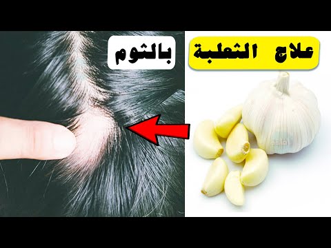 علاج الثعلبة بالثوم