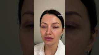 Верхняя блефаропластика +кантопексия