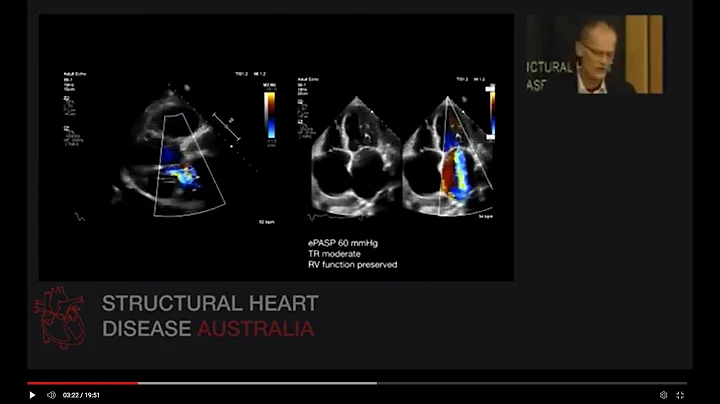 Case - Secondary Mitral Regurgitation - Mitral Cli...