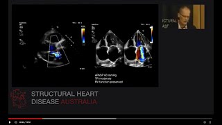 Case - Secondary Mitral Regurgitation - Mitral Clip - Dr Peter Hansen