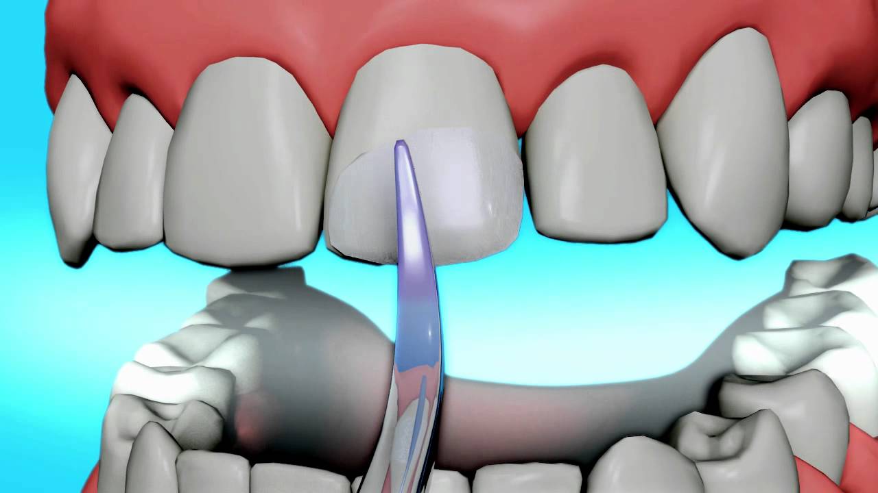 Dental Bonding Video  Tooth Bonding 