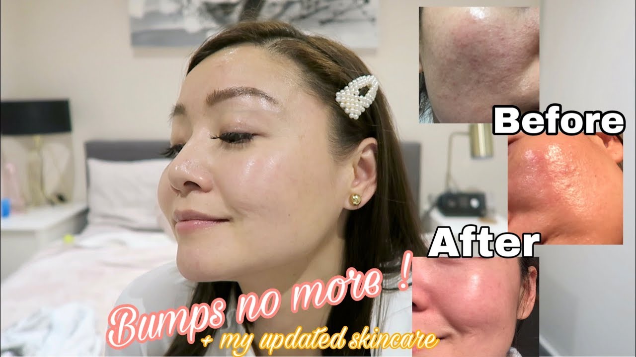 skincare for tiny bumps