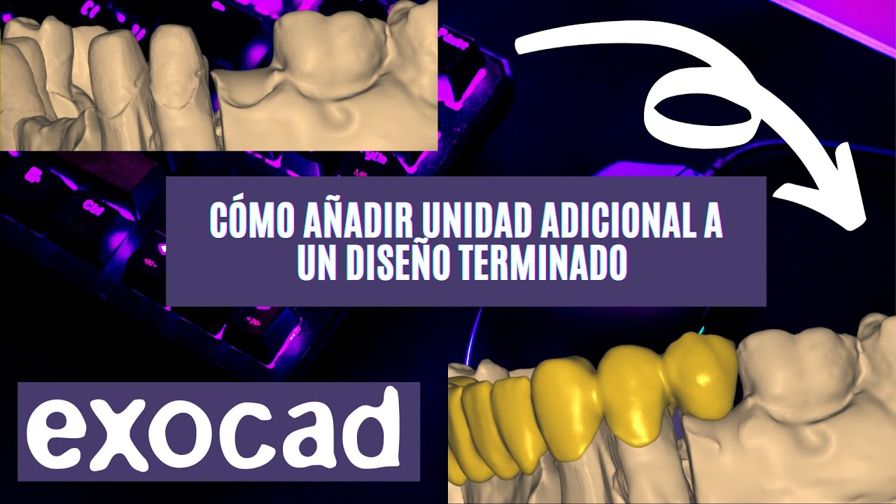 Cómo añadir pieza dental adicional a un diseño terminado en EXOCAD🔥