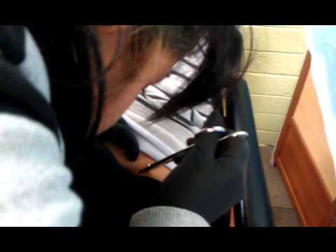 Hip Dermal Piercing Removal YouTube hip-dermal-piercing-removal-youtube