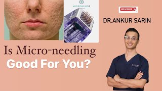 Facts about micro needling | Acne Scar Treatment | Dermapen 4 | Morpheus 8| Dermaroller| Dr. Ankur