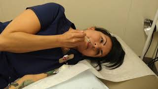 Technique for SPG block (without catheter) for patients