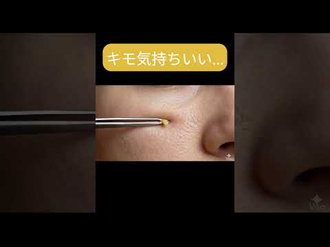 【超爽快】角栓を引き抜くASMR🧶✨ ゆっくり・なめらか・気持ち良すぎる【キモイ】114