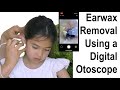 Earwax Removal Using a Digital Otoscope at Home