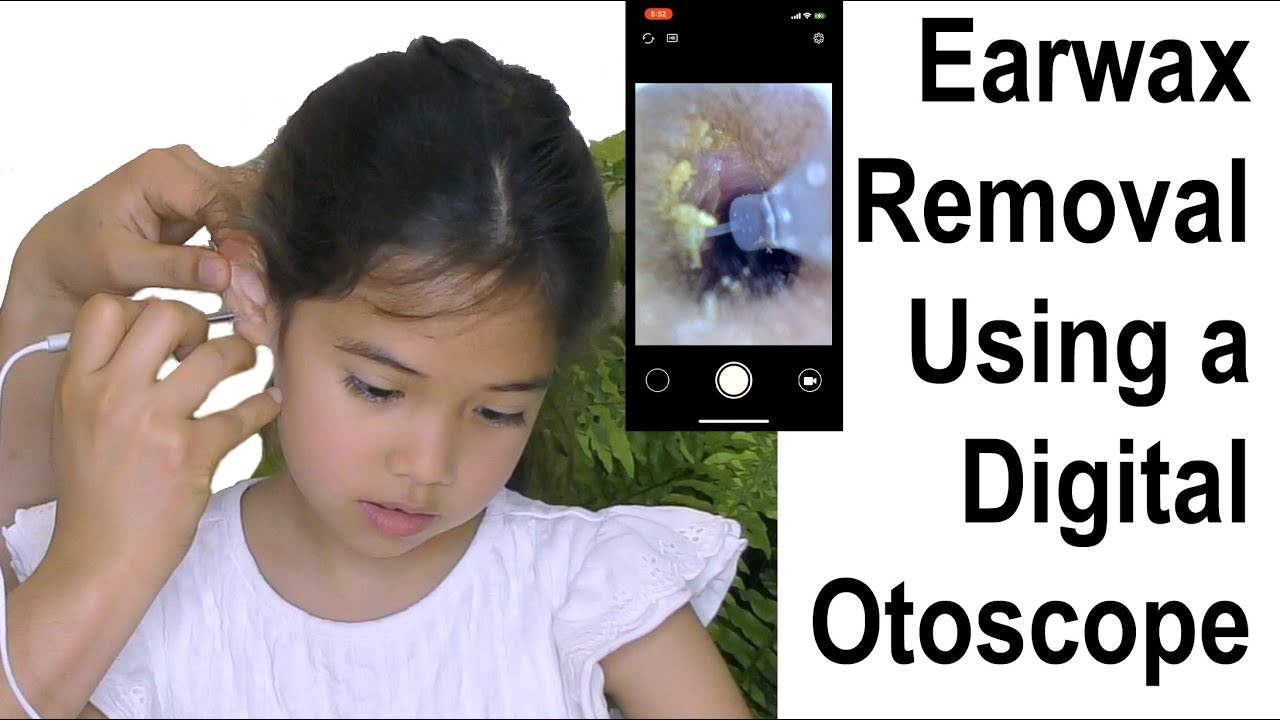 VITCOCO Ear Wax Removal Kit, Otoscope Ear Camera 1920P HD Ear Cleaning –  Vitcoco Online