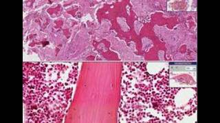Histopathology Bone--Paget disease