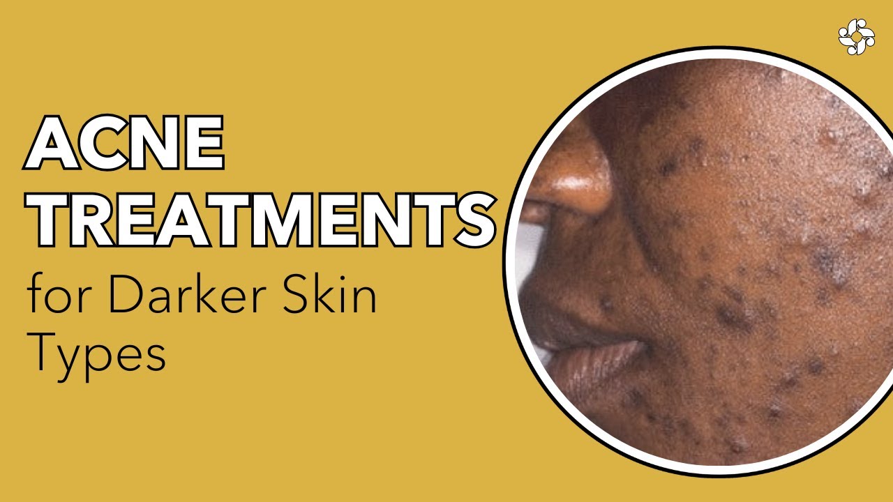 Acne Treatments for Darker Skin Types | Skin & Body Concerns