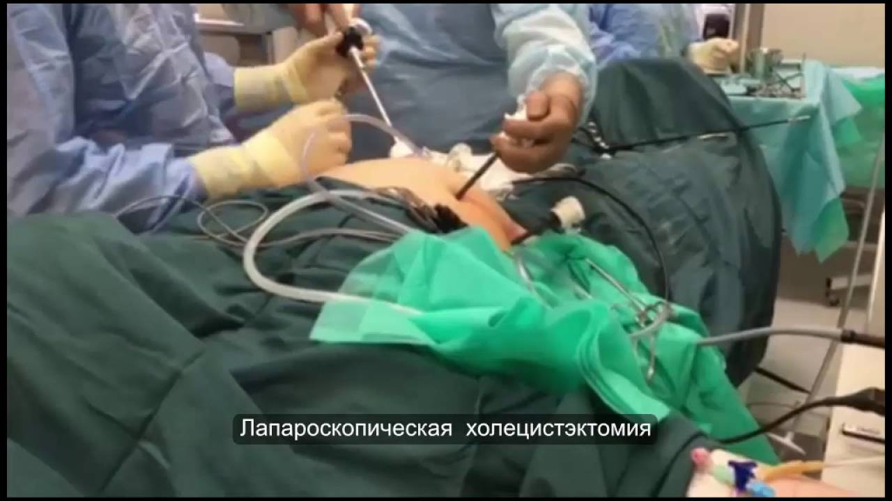 Лечение желчекаменной болезни, лапароскопическая холецистэктомия ...