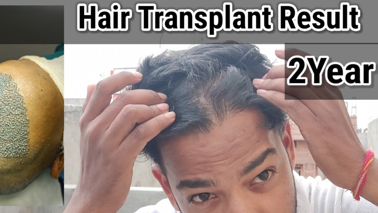 Hair Transplant results After 2 year! Hair transplant results Hindi ...