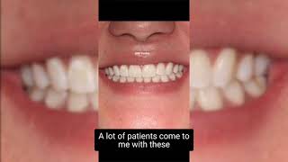 Removing White Spots on your Teeth | Cosmetic Dentistry | Dr. Yazdan