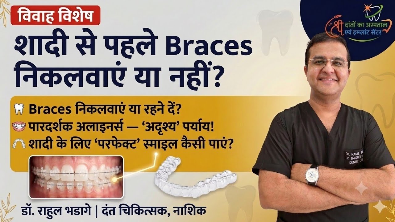 Braces Before Your Wedding? Clear Aligners vs Braces