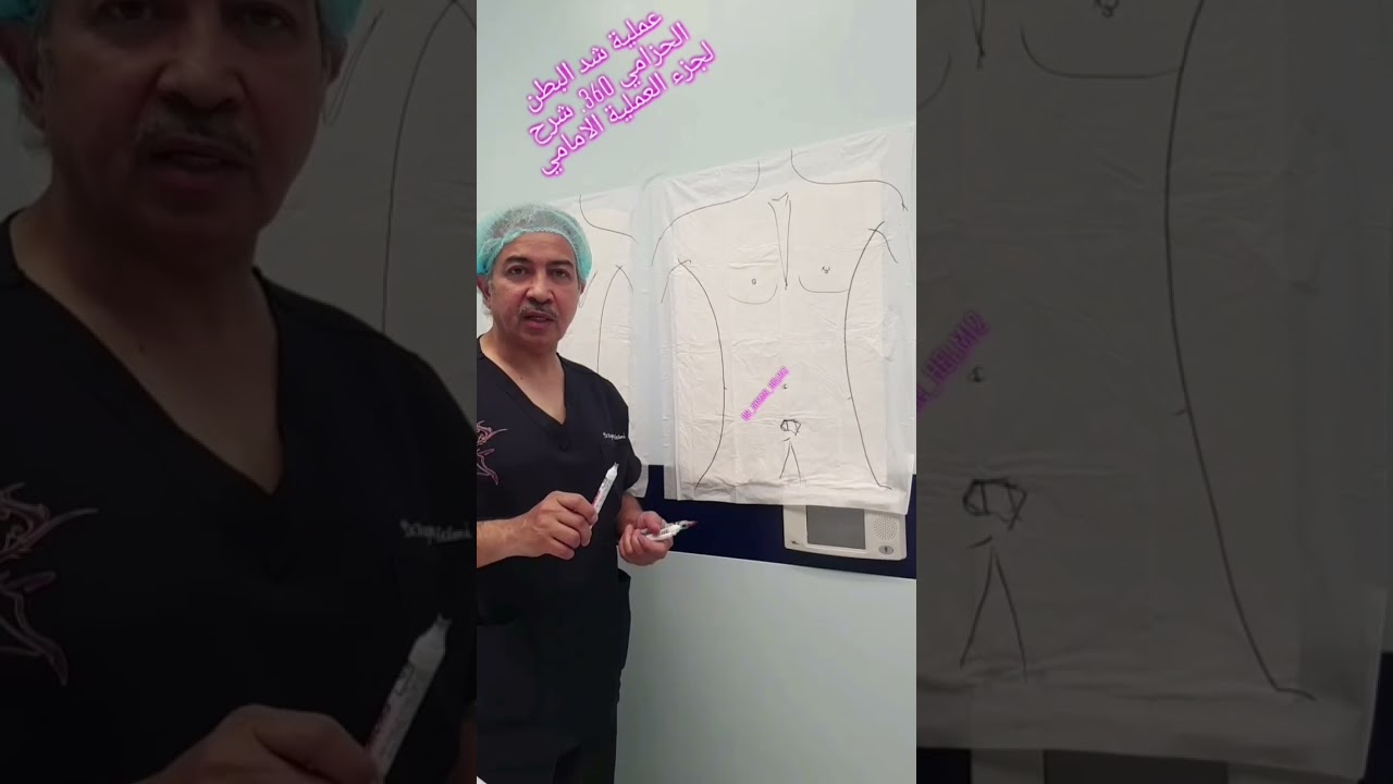 شد البطن الحزامي( الدائرة كاملة ٣٦٠ درجة) د أيمن حلمي يشرح تفاصيل العملية وشكل الجرح .