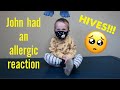 MY TODDLER HAD AN ALLERGIC REACTION….