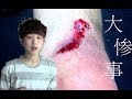 【グロ】スケボーで大惨事【まさかの結末!?!?】
