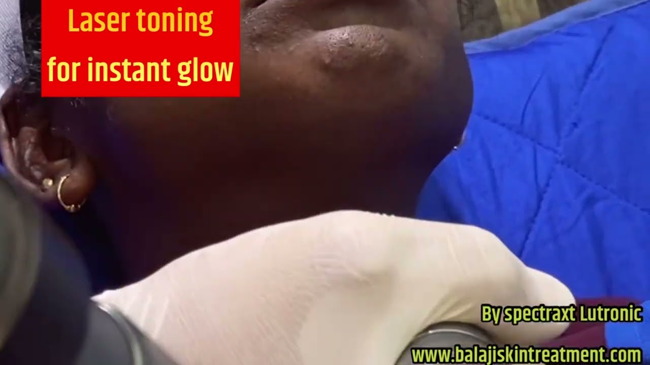 Laser Toning/ Glow on Demand on face by Spectra XT LASER US FSA APPROVED