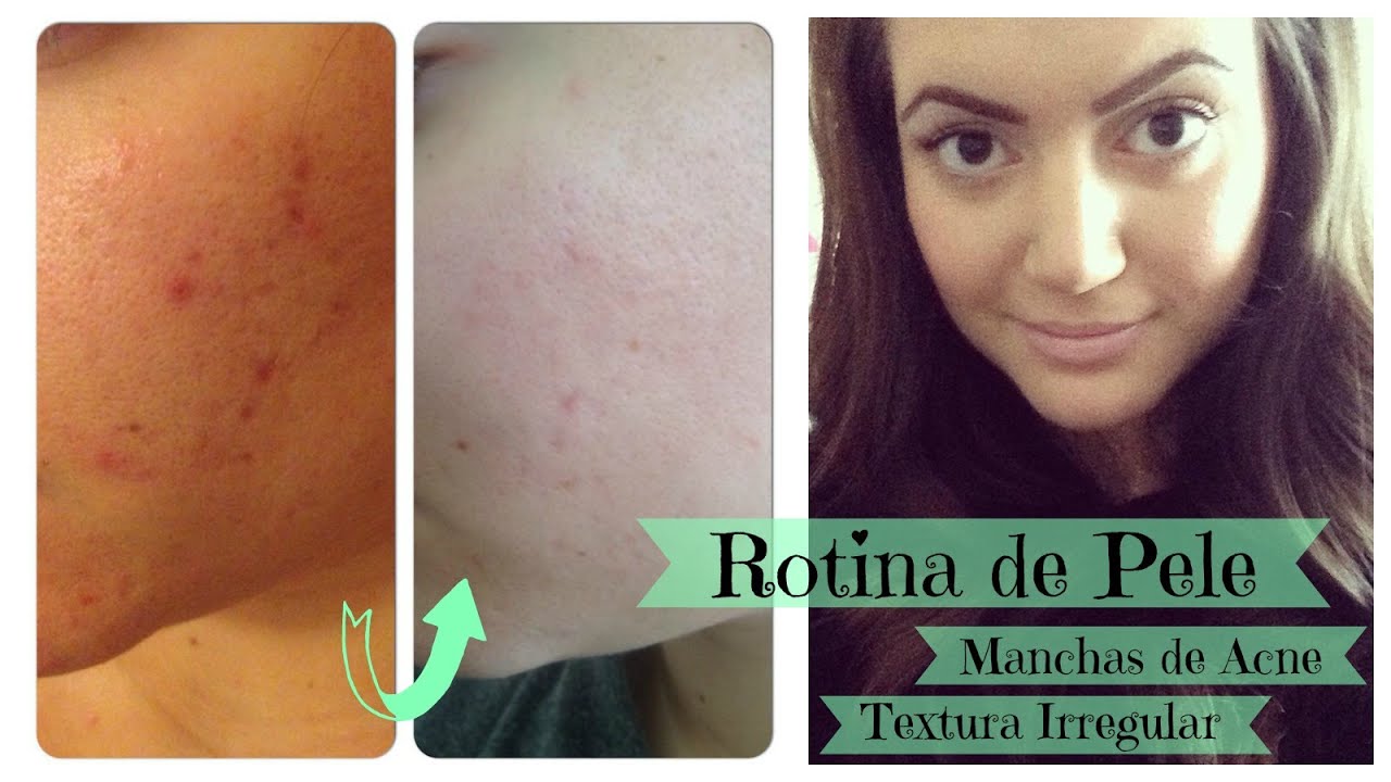 Oli cosmetici e acne