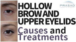 How to Treat Upper Eyelid and Brow Hollowing, and the Advantages of Non-Surgical Treatment