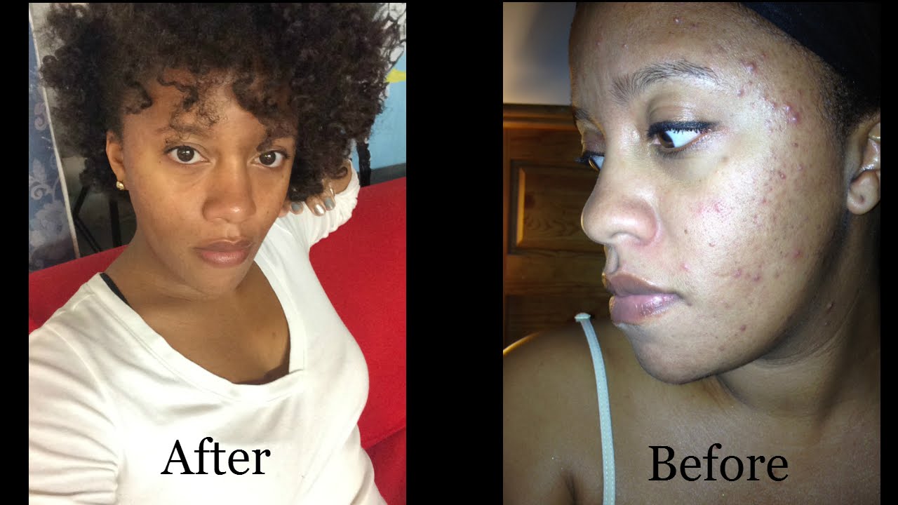 Skin Care Regimen Get Rid of Your Acne YouTube