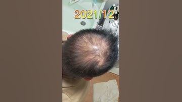 Thumbnail of ハゲの薬 半年試した結果デュタステリド