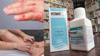 স্ক্যাবিস ও চর্মরোগের চিকিৎসা  | Lorix Plus Lotion ব্যবহার করার নিয়ম dermatology