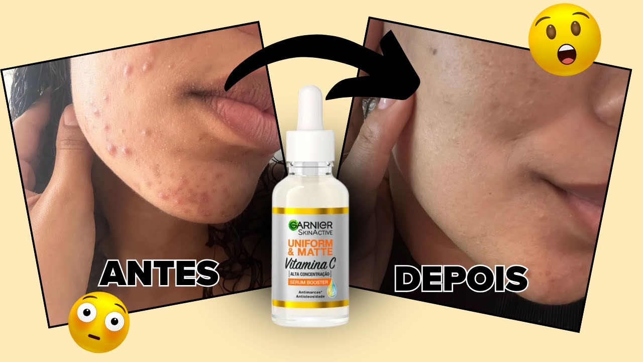 Controle as espinhas e diminua as manchas na pele com o Sérum de ...