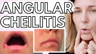 Lip Eczema & Angular Cheilitis - 10 TIPS for Dealing with Eczematous Angular Cheilitis screenshot 2