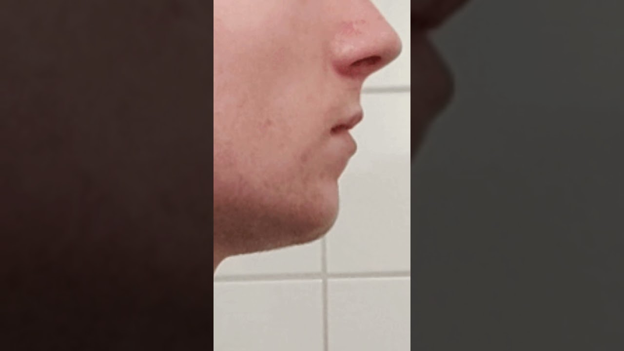 Receding chin fix