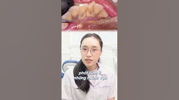 Đừng để cao răng là trở ngại khi niềng răng | WaterBeam #shorts