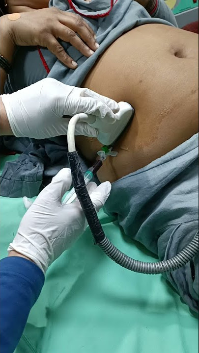 USG guided hemoperitoneum aspiration