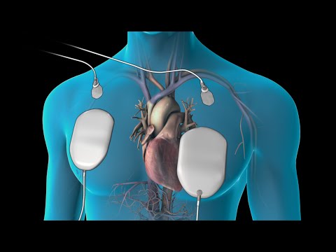Cardioversion (for Atrial Fibrillation)
