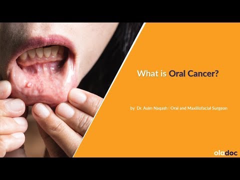 Best Dentist in Lahore - Dr. Asim Naqash Talks About Oral Cancer thumbnail image