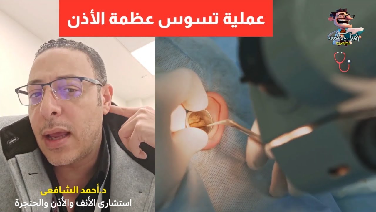 مرض تسوس عظام الأذن اعراضه وعلاجه | اهلا يا دكتور تخصص أمراض الأنف والأذن والحنجرة تسوس عظام الأذن