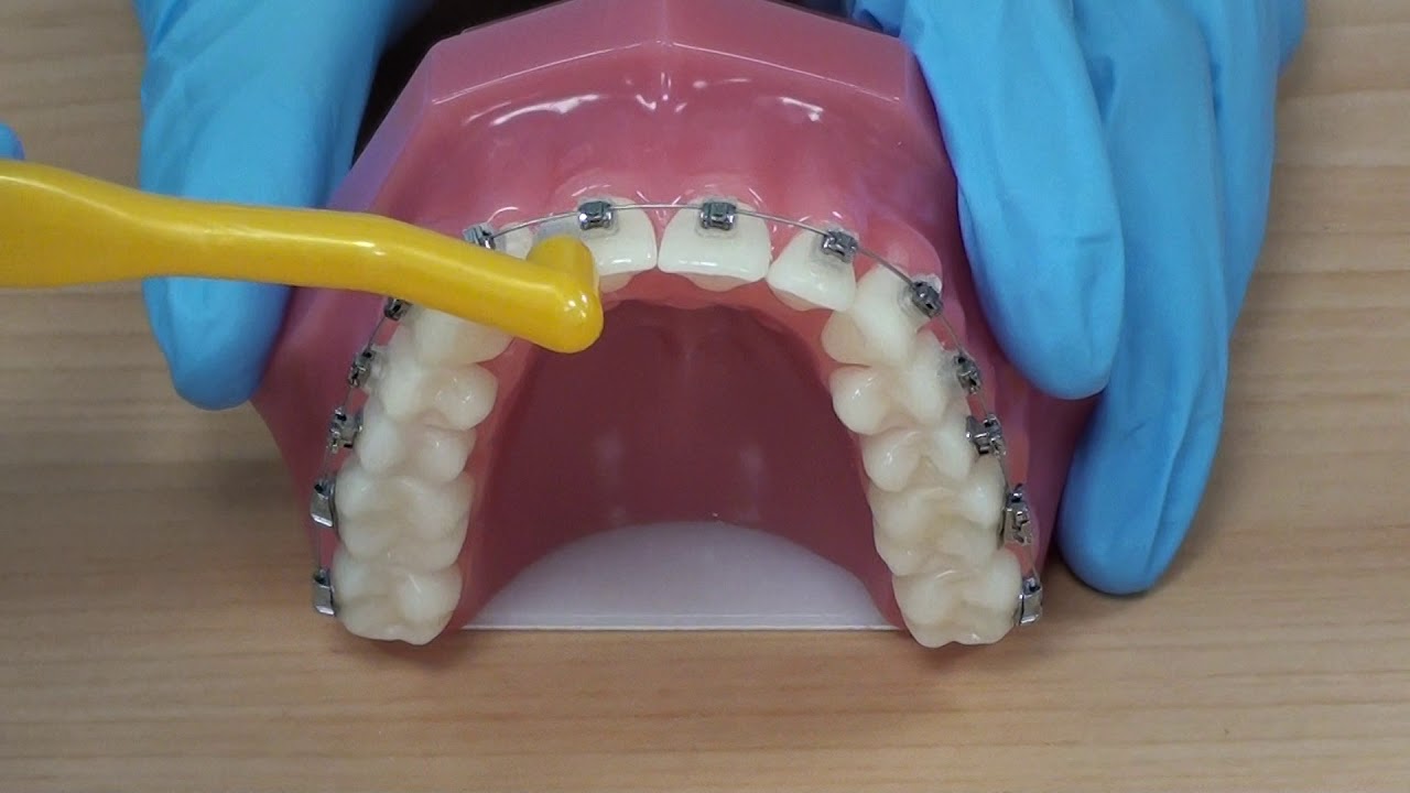 Using a single tufted brush with fixed braces. YouTube