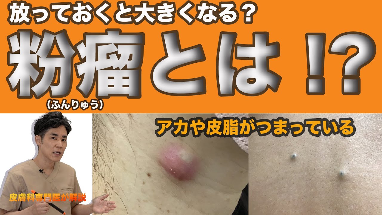 粉 瘤 潰れ た