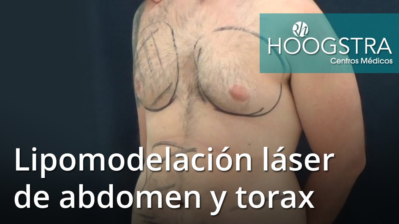 lipoma 意味 Lipomodelación láser de abdomen y torax (16037)
