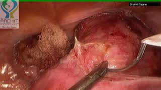 Laparoscopic Pectopexy By Dr Amit T