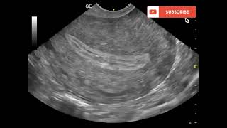 early pregnancy ultrasound(intradecidual sign)